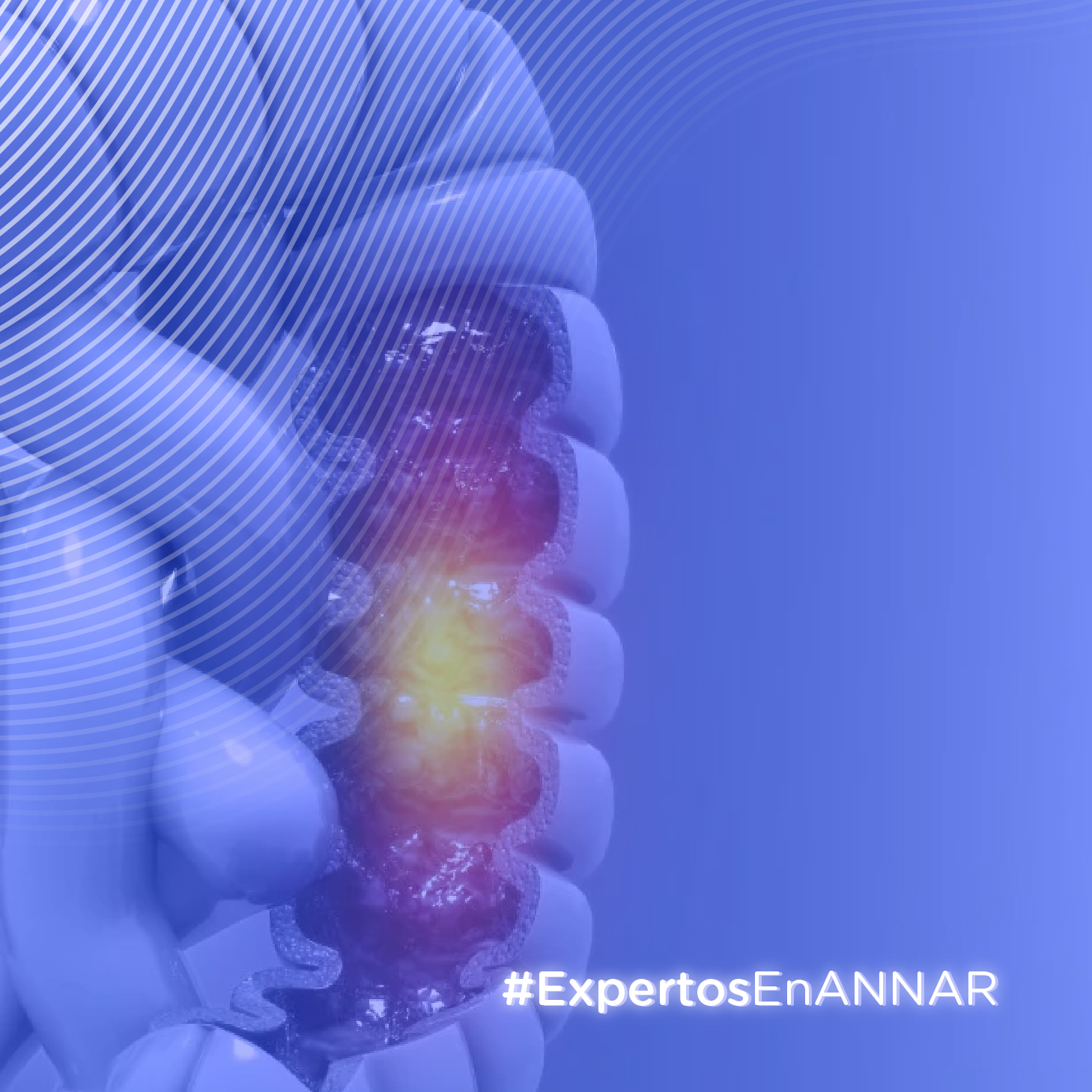 ANNAR-DX-articulo-Cáncer Colorrectal Una Realidad en Aumento en Colombia-miniatura