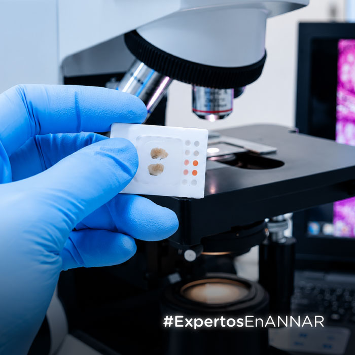 Annar-DX--La-importancia-de-la-fase-preanalítica-en-el-diagnostico-de-PDL-1-articulo-web-miniatura