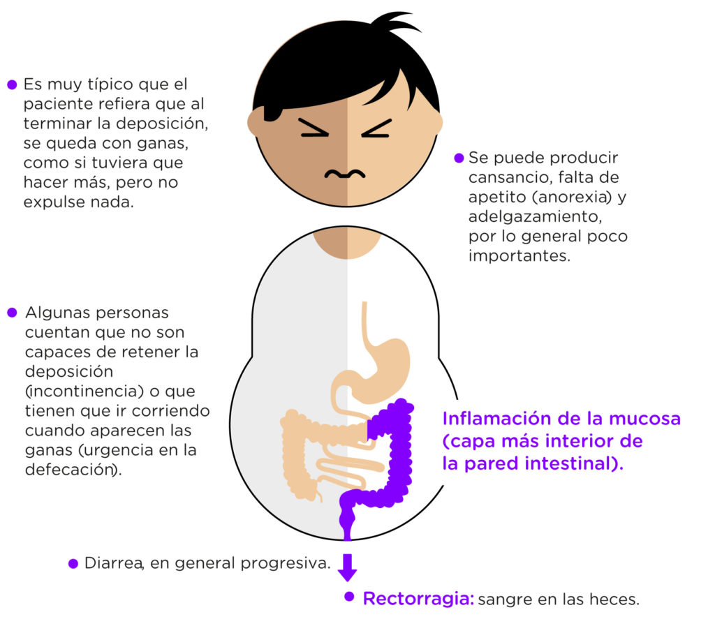 La enfermedad inflamatoria intestinal (EII) se define como un trastorno constituido por dos entidades clínicas diferentes: la colitis ulcerosa (CU) y la enfermedad de Crohn (EC). El denominador común es la presencia de inflamación crónica a nivel intestinal, que suele acompañarse de manifestaciones extradigestivas.