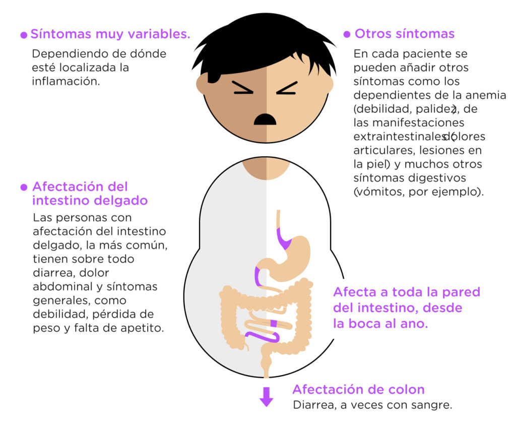 La enfermedad inflamatoria intestinal (EII) se define como un trastorno constituido por dos entidades clínicas diferentes: la colitis ulcerosa (CU) y la enfermedad de Crohn (EC). El denominador común es la presencia de inflamación crónica a nivel intestinal, que suele acompañarse de manifestaciones extradigestivas.